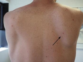 shoulder blade scapular disorder